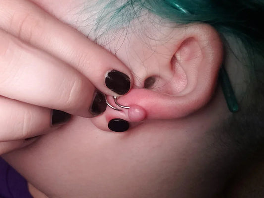 Piercing Bump vs Keloid: A 4-Type Comparison Chart to Identify What You Have