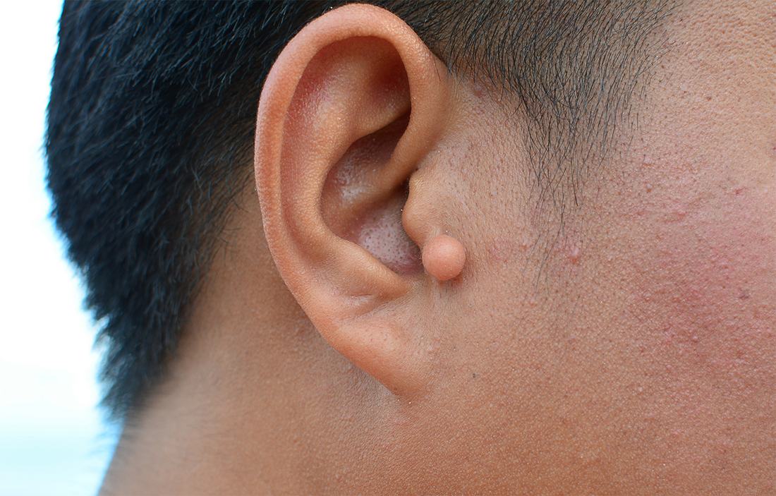 Piercing Bump Treatment at Home: Identify Your Bump Type and Fix It the Right Way